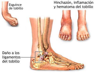 ESGUINCE DE TOBILLO