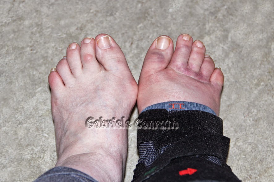Fuß umgeknickt schmerzen nicht geschwollen