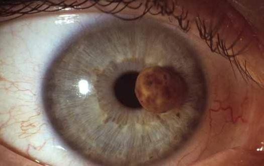 Rhabdomyosarcoma Cat S Eye Rhabdomyosarcoma Cat S Eye