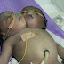 ولادة نادرة لطفلة برأسين بشرق السودان