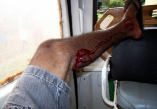 São Francisco: Ataque de cães Pit Bull deixa 2 pessoas feridas | Cacoal