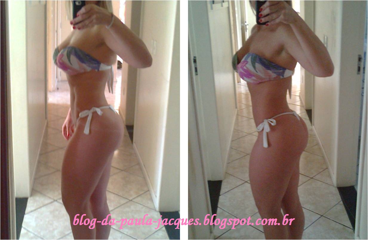 Peito de implantes barato