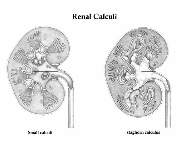 Renal Calculi/Kidney stone