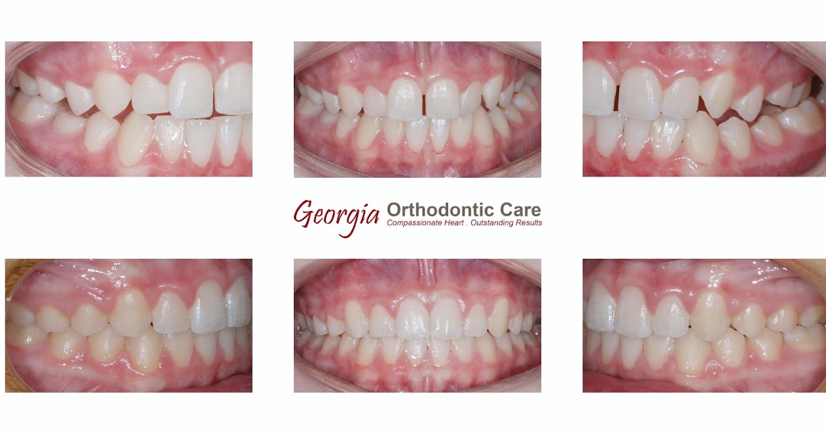 ORTHODONTIC CARE LAWRENCEVILLE & NORCROSS GA Unilateral