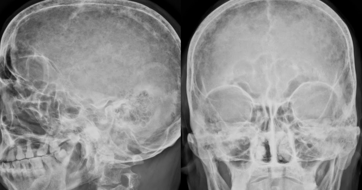 myeloma ct skull