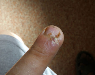 Slowly the gammy finger gets better Slowly the gammy finger gets better