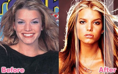 Jessica Simpson Plastic Surgery