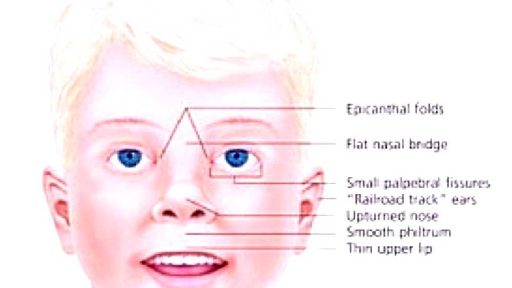 Prader Willi Syndrome