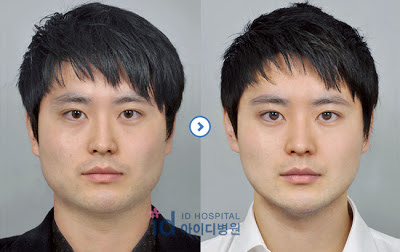 ID Hospital Korea: Prominent Mandible Angle