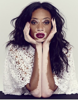 Mannequin Winnie Harlow Vitiligo égérie Deisgual Mode Découverte