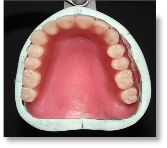 Step by step Guide for Understanding the Prosthodontics Complete