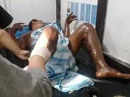 Nursing_ @Budie29: Standard Operasional Prosedur Perawatan Luka Bakar