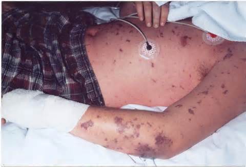 Side Effects and causes of Meningitis ~ Health Care, Slimming Tips