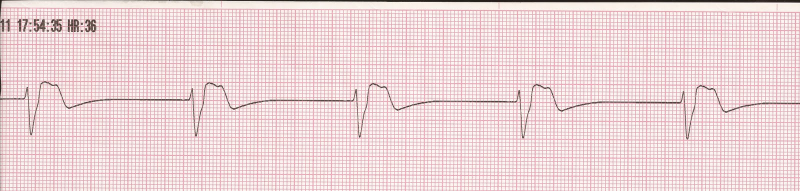 ventricular fibrillation pulseless electrical activity ecg ventricular fibrillation pulseless electrical activity ecg
