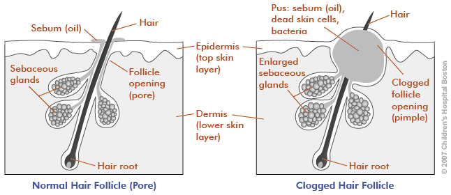 large pores clogged pores