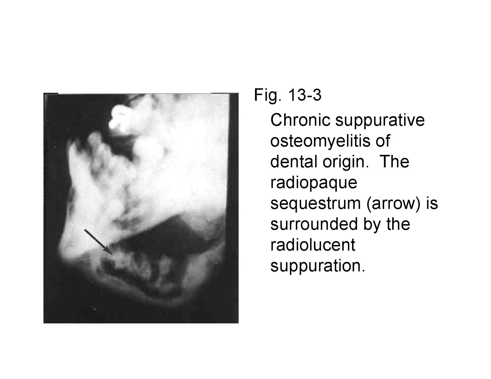 Osteomyelitiswith Radiological features Dentistry and Medicine