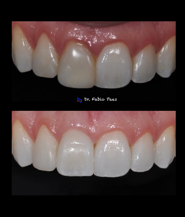 Implante Dentário Goiania – DR. FABIO PAES - ESTÉTICA BUCAL: Faceta de