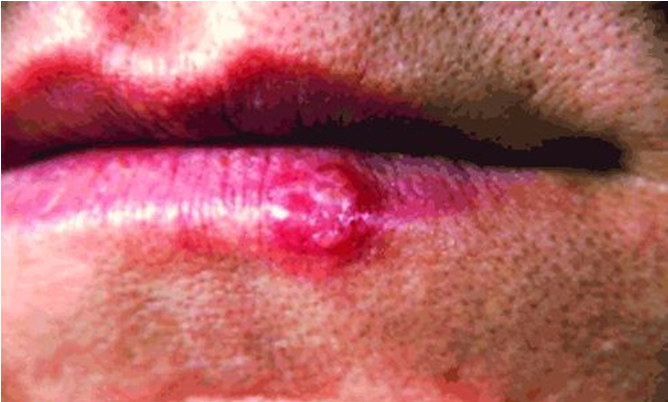 MBBS Medicine (Humanity First): VIRAL INFECTIONS OF THE SKIN