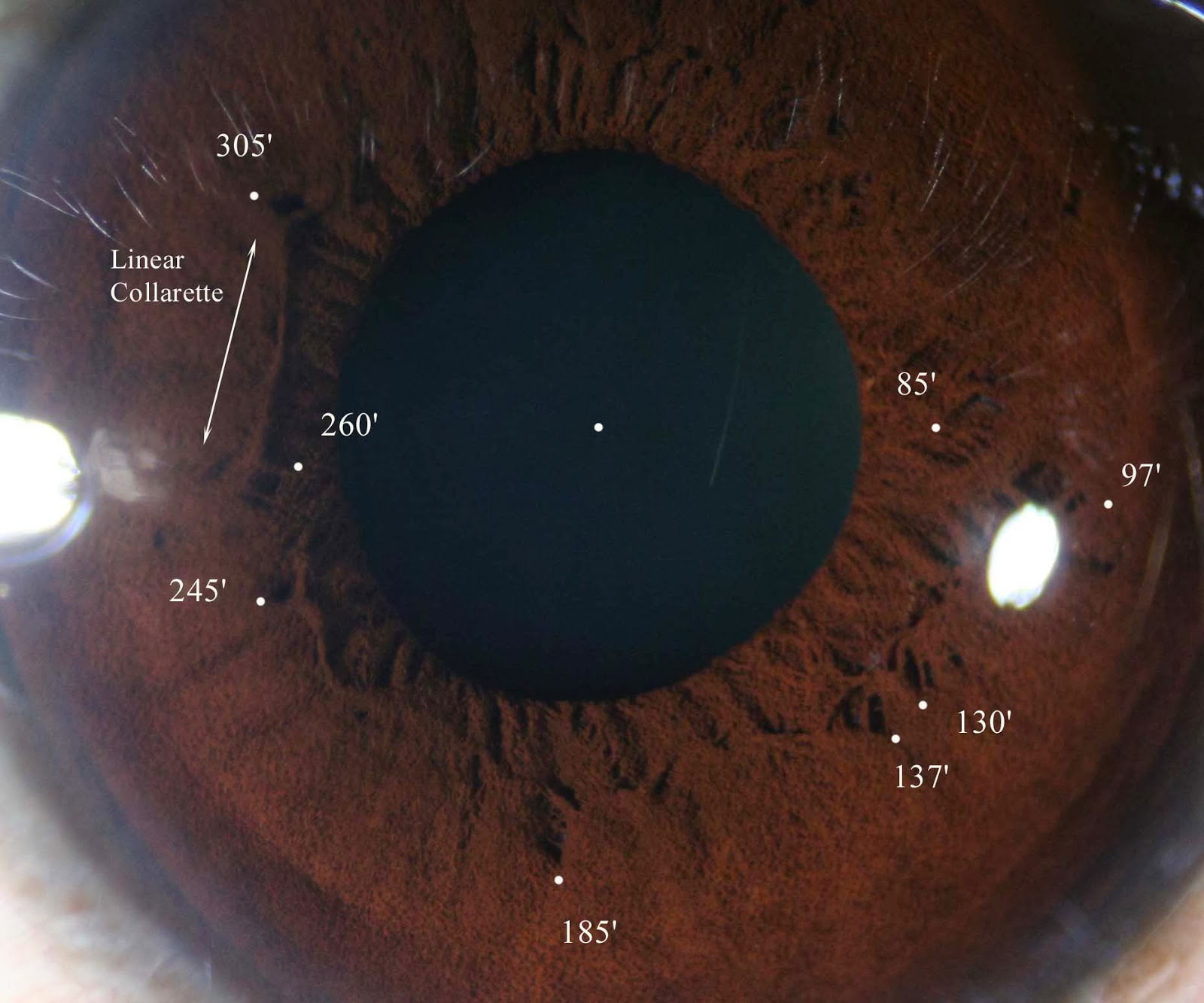 Modern & Multidimensional Iridology Crypts at Pupillary Zone