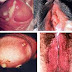Obat Nyeri Kencing Keluar Nanah dari Lubang Vagina thumbnail