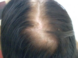 Female Celebrities with Hair Loss Female Celebrities with Hair Loss