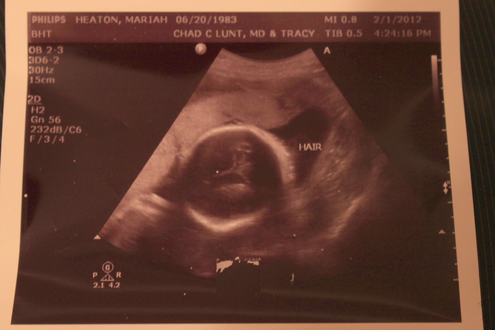 Hair On Ultrasound