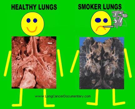 Image result for lungs before and after cigars