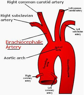 Brachiocephalic trunk; Innominate Artery