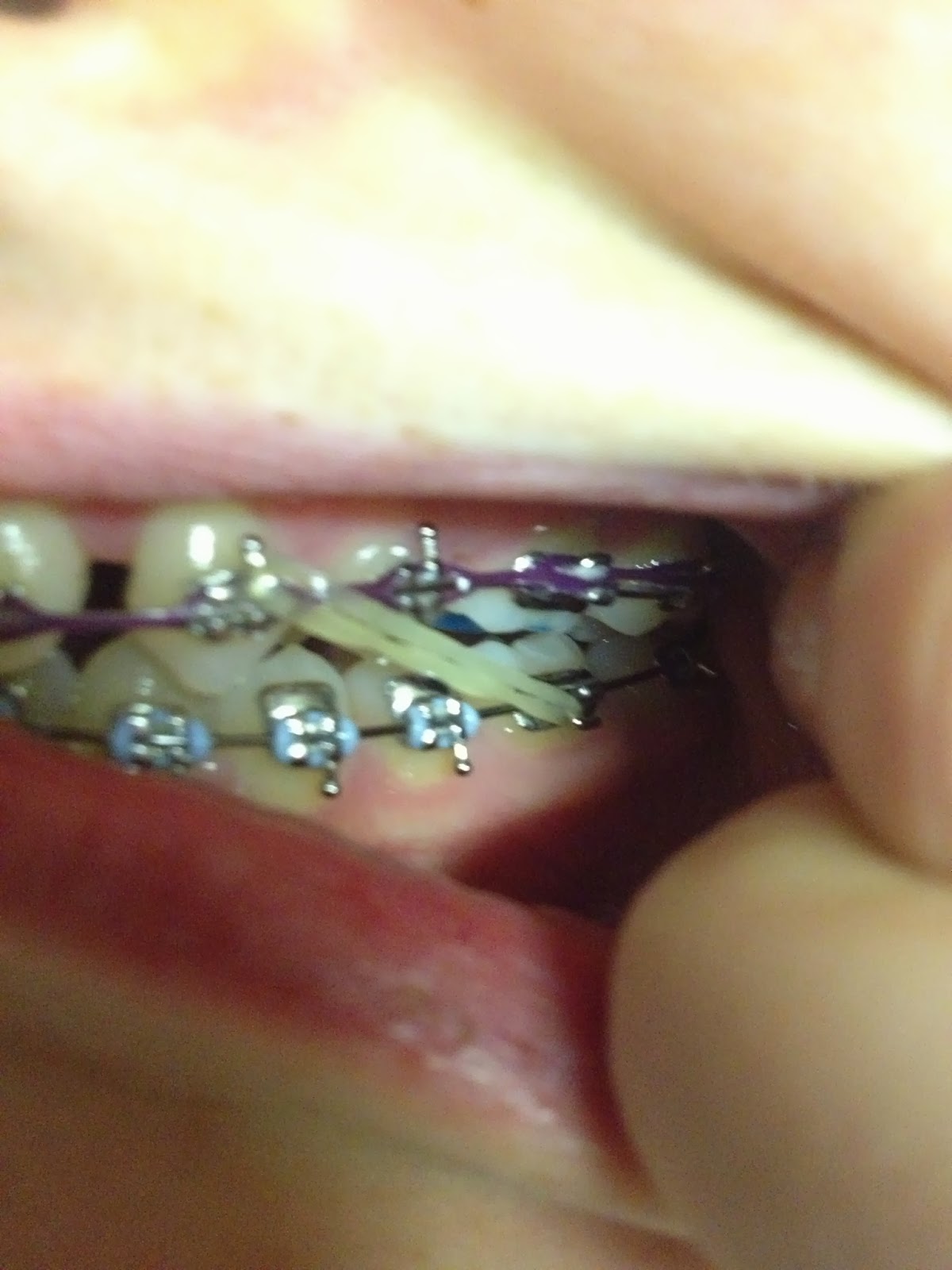 Orthodontics and braces • Stouffville SMILES Dentistry & Orthodontics