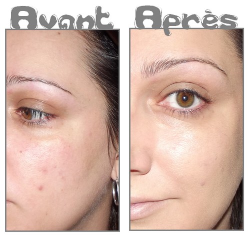 Bronze la personne sans pigmentation