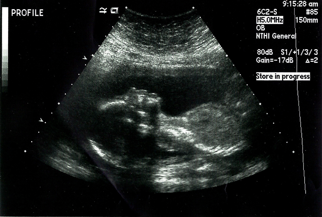 The Felixtionary: Ultrasound: Boy or Girl?