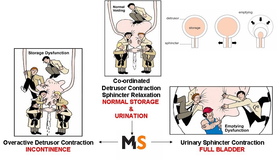 Multiple Sclerosis Research: Finding Bladder problems