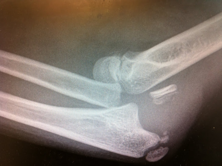 Fracture dislocation elbow