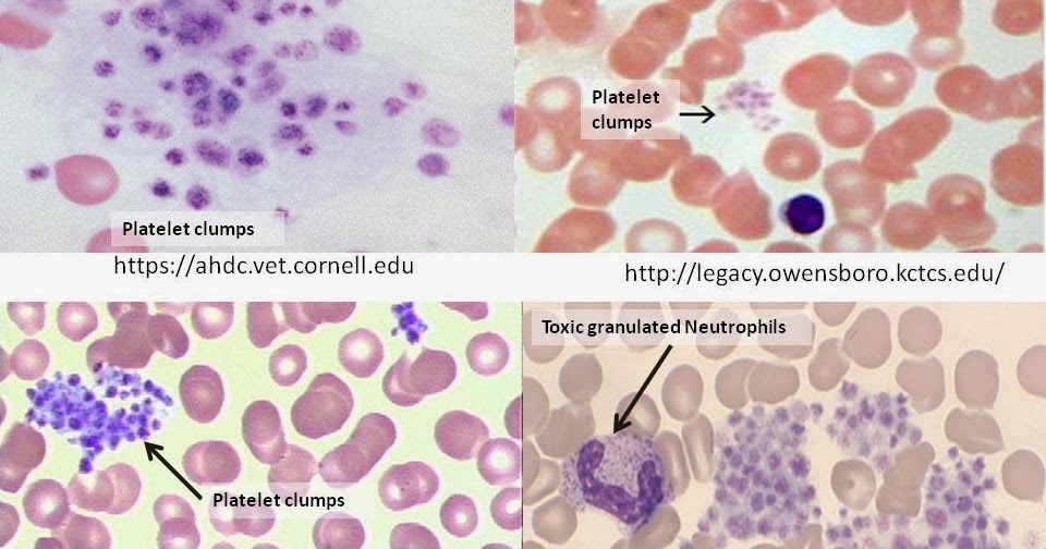 Haematology in a NutShell Platelet Clumps