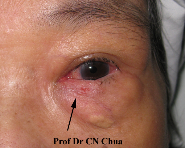 Eyelid Surgery by Prof Dr CN CHUA 蔡鐘能 Squamous cell
