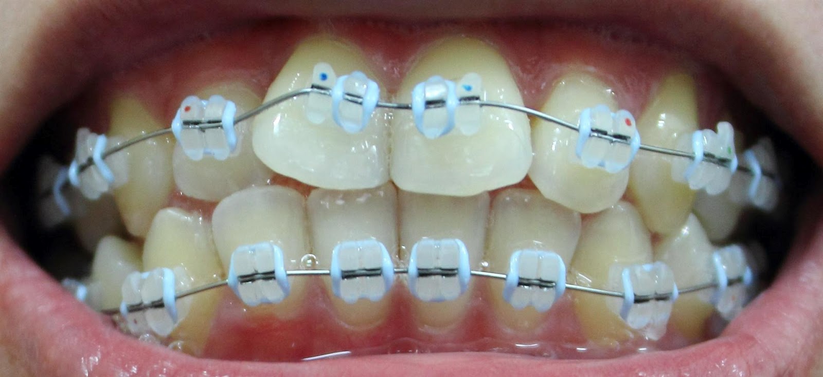 Braces at 25 11 Sep 2012