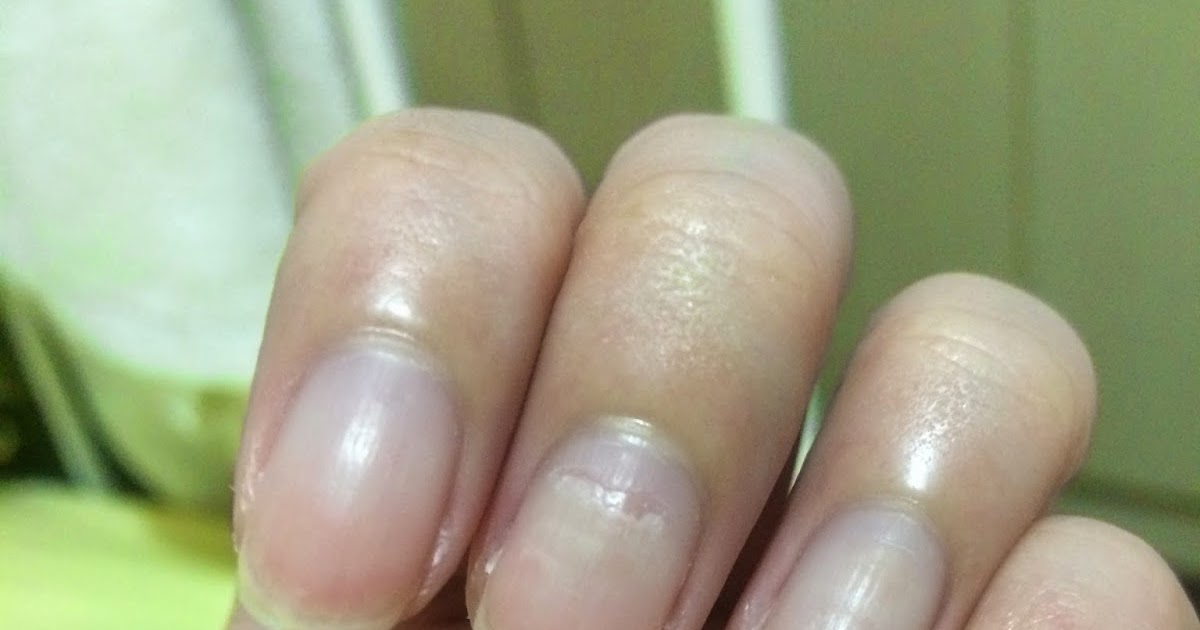 The Dettol Diaries Peeling Fingernails after HFMD