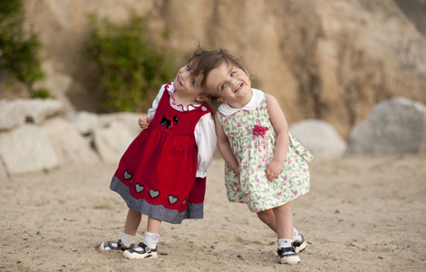 I Wanna Be Craniopagus Conjoined Twins Pictures