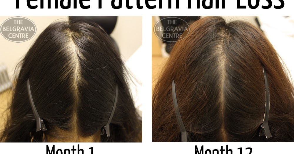 Hair Treatment Overview Why Do Women Go Bald