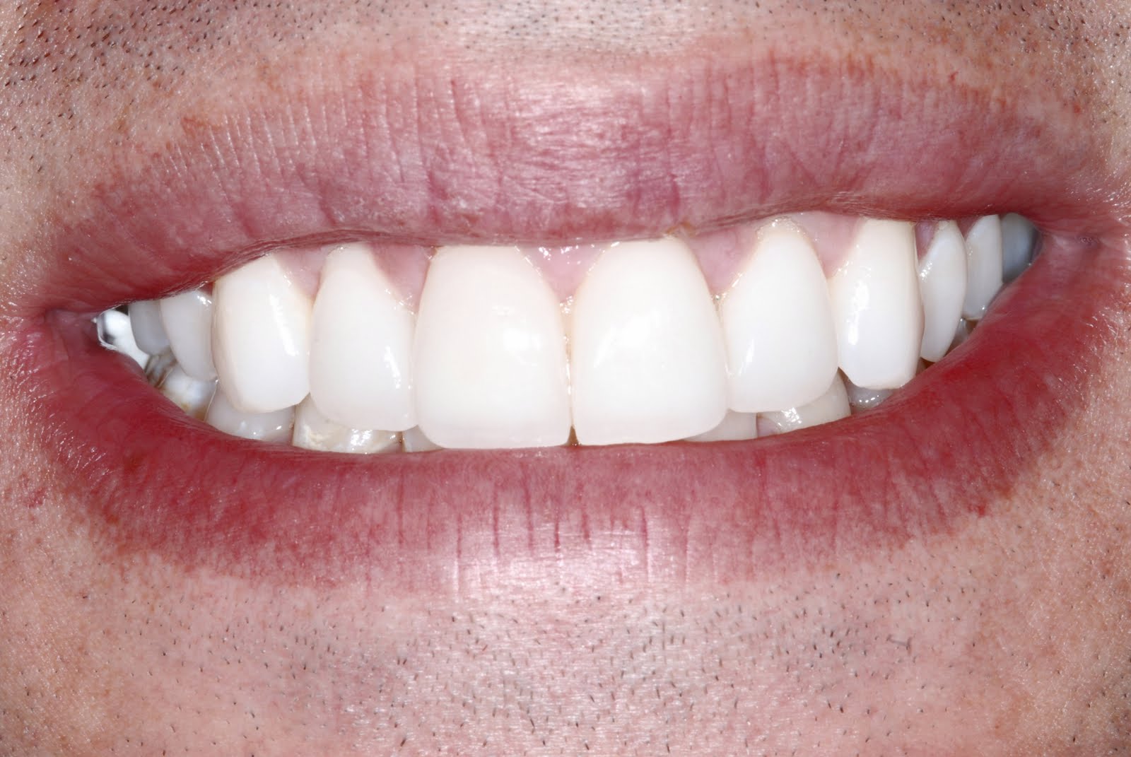 Crabapple Dental Before and After Cosmetic Dentistry