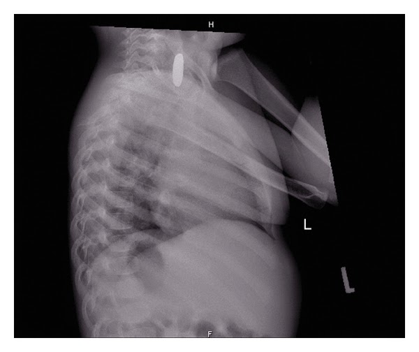 Random Rambles Button battery vs coin ingestion