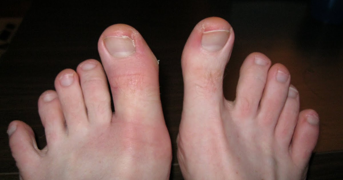 Robinsby Acres Day 13 Supplemental (a fat toe!)