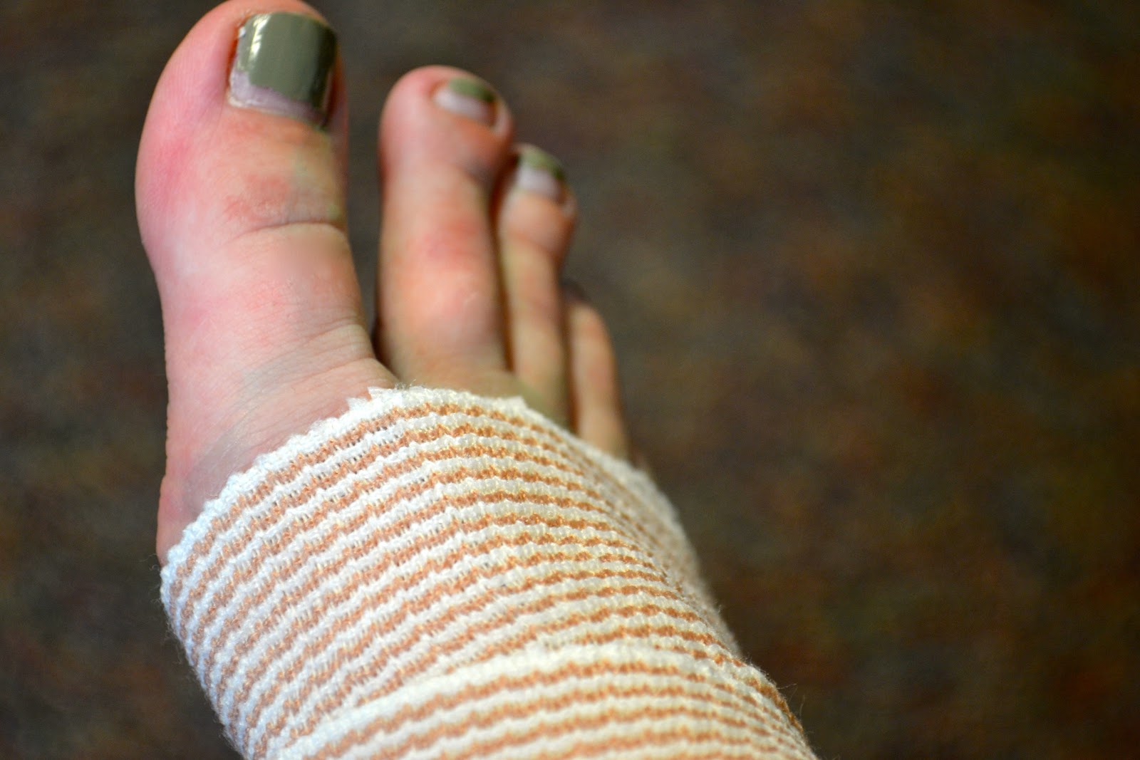 My Broken Ankle Screw Removal