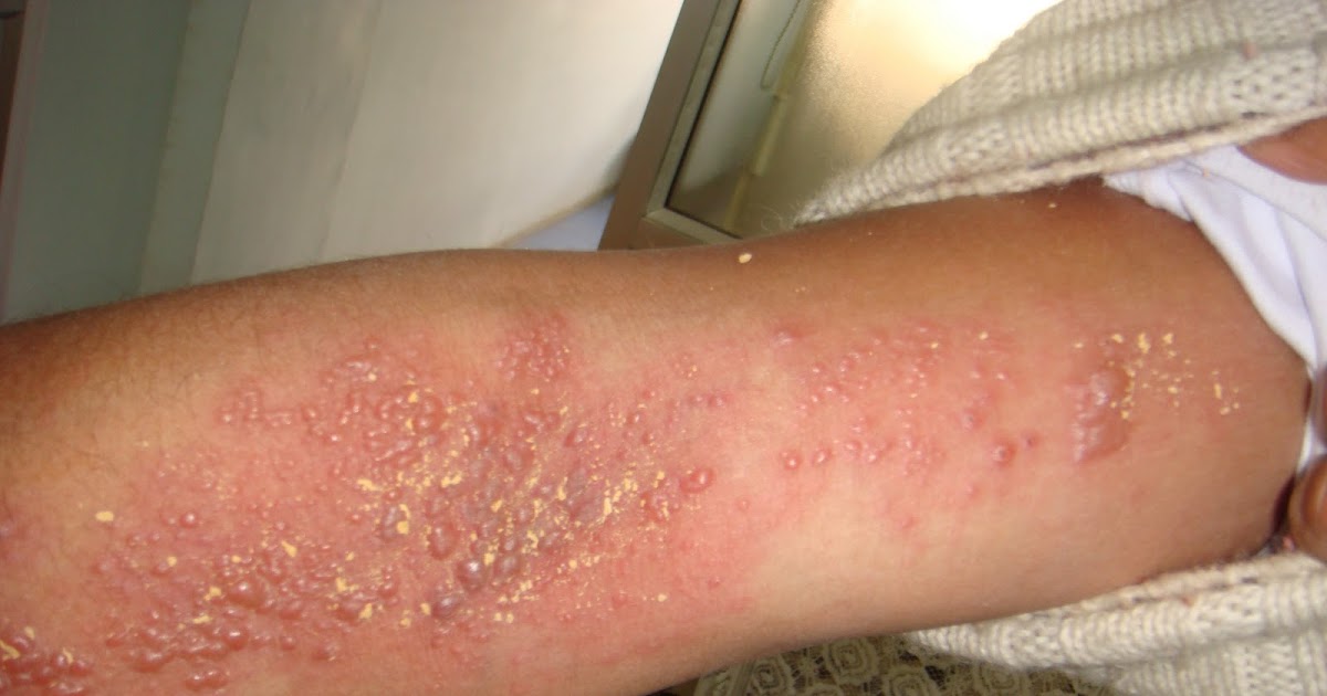 Herpes Zoster Treatment Homeopathy What Is Eczema Herpeticum Herpes