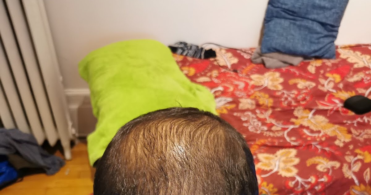 Hairloss Treatment Update | Down 100 Finesteride Tablets