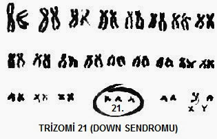 down sendromu, trizomi 21, mongolizm