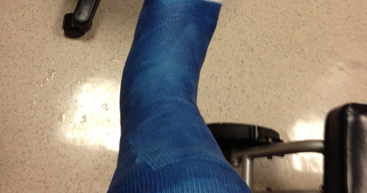 The surgical recovery of and surviving a fully ruptured peroneal long tendon New Cast
