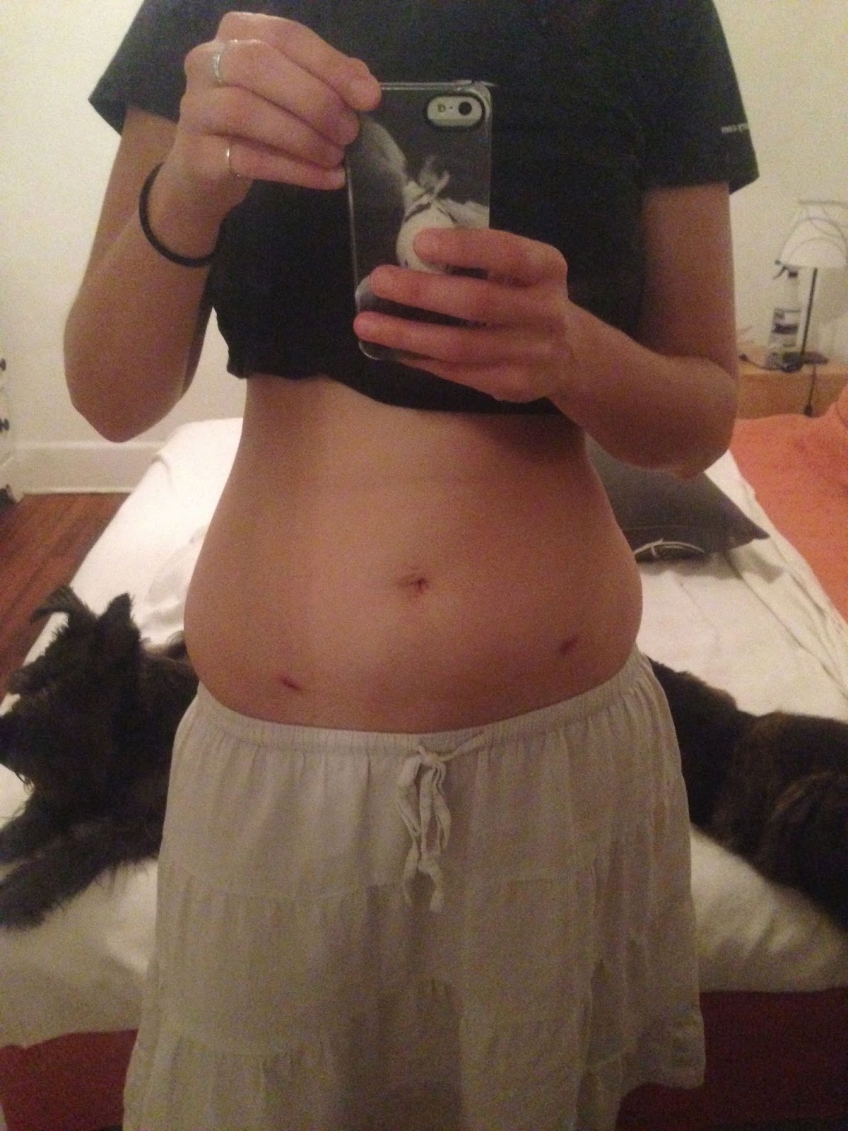 The Snarky Writer Getting My Laparoscopic Bilateral Salpingectomy