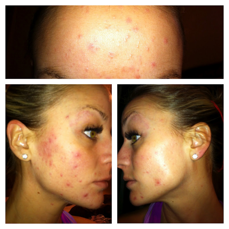 can i ovulate late with clomid