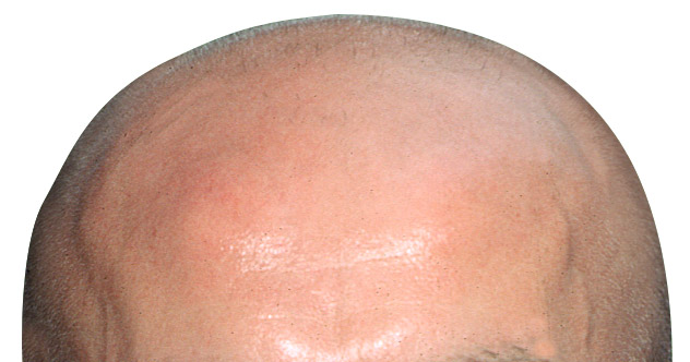 bald scalp